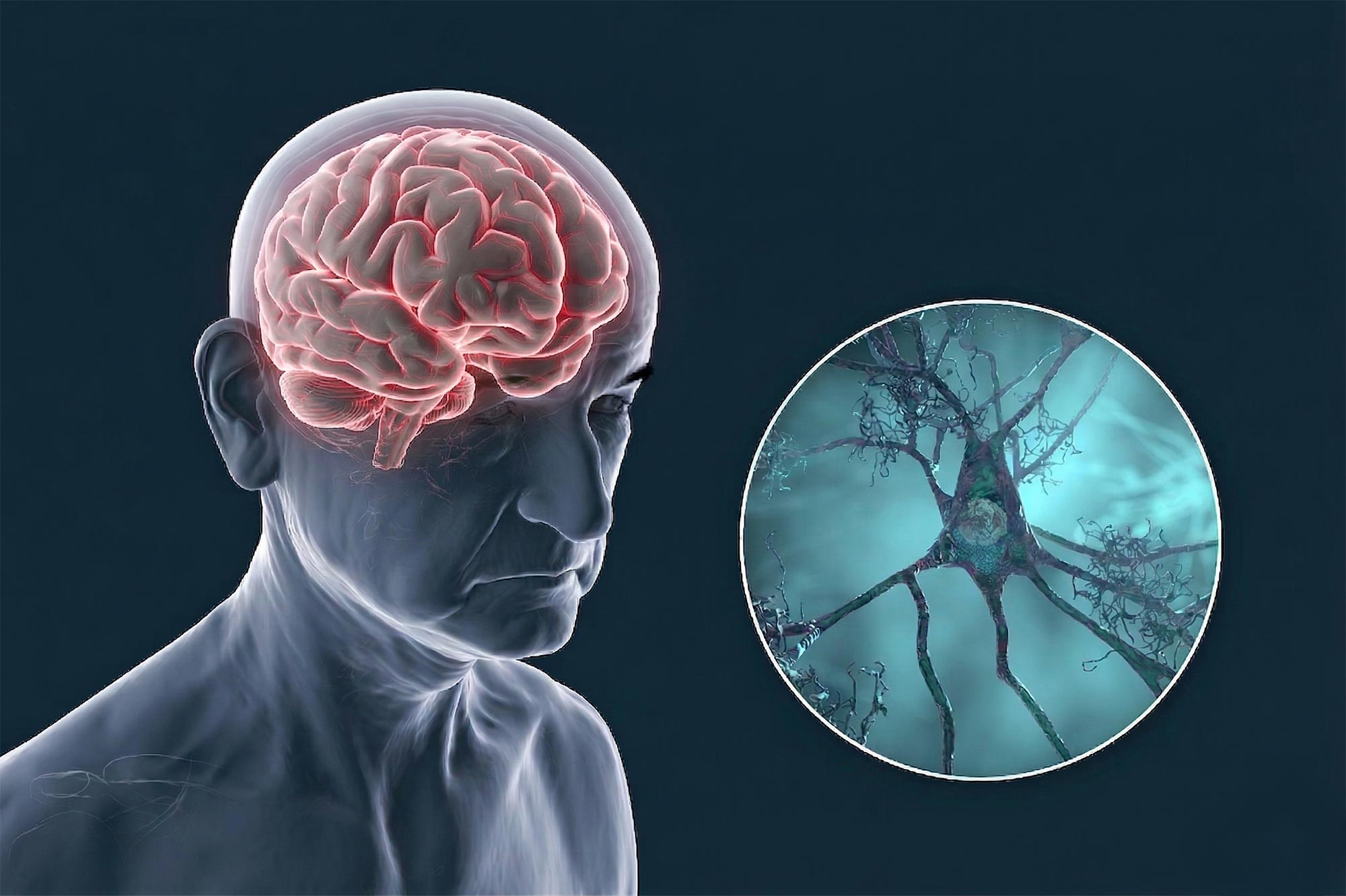 Naukowcy wzywają do całkowitego przemyślenia leczenia choroby Alzheimera