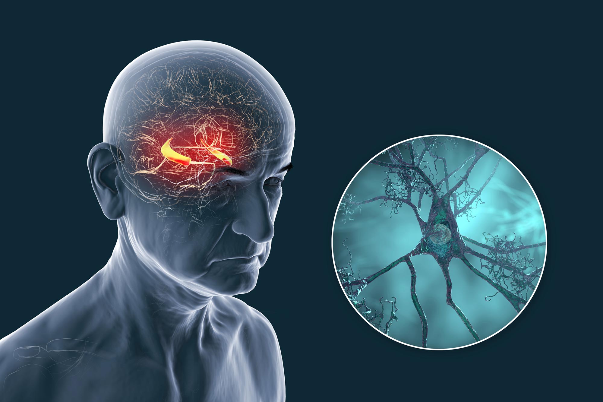 Nowe badanie podważa teorie dotyczące choroby Alzheimera: nie chodzi tylko o płytki nazębne